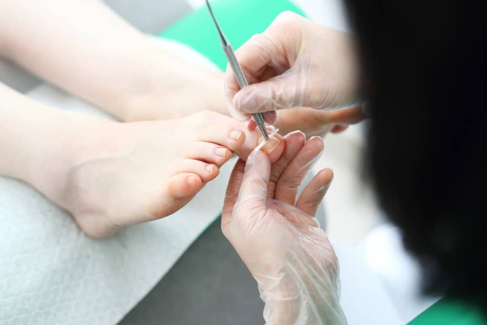 treating ingrown toenails at home