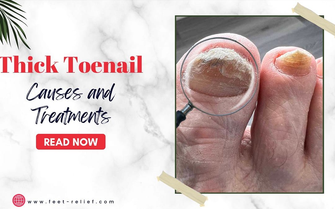 Thick Toenail Causes and Treatments