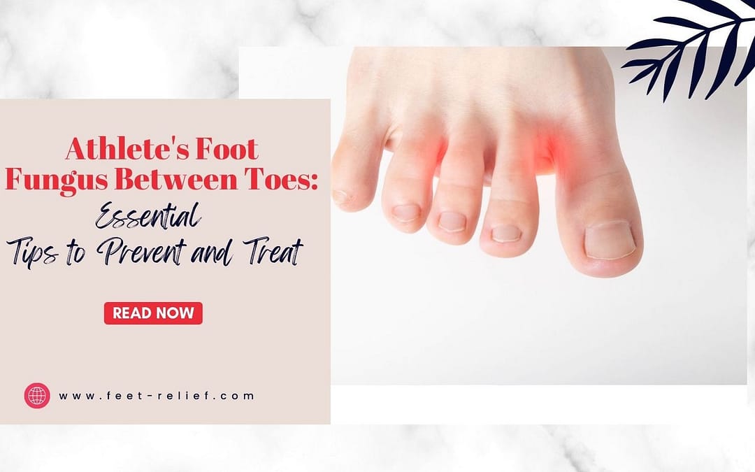 Athlete's Foot Fungus Between Toes: Essential Tips to Prevent and Treat