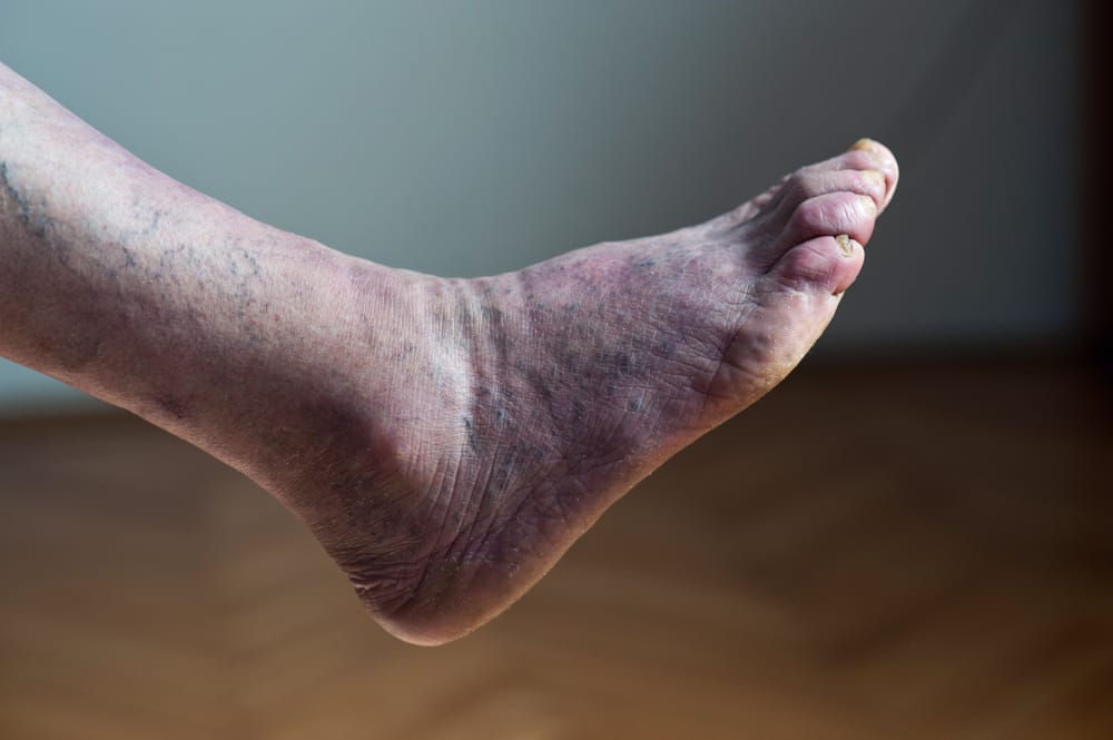poor circulation in the elderly