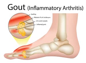 Common Foot Problems in Elderly