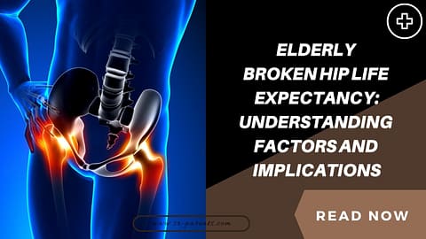 Elderly Broken Hip Life Expectancy Understanding Factors and Implications